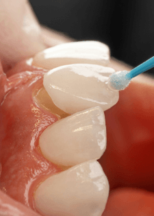 close-up of fluoride varnish being applied to a patient’s front teeth with a small blue applicator during a dental treatment
